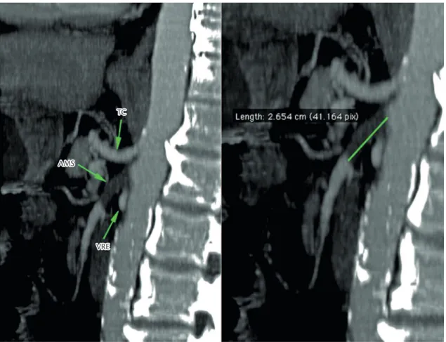 Figure 1. Preoperative showing proximal occlusion of the SMA (2.6 cm long).