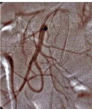 Figure 4. Follow-up control angiotomography 3 weeks af- af-ter surgery showing a patent stent  with normal blood low  through the lumen and no signs of residual stenosis.