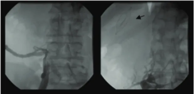 Figure 3. No low in inferior vena cava, and vena cava ilter  displaced due to space-occupying process (arrow).