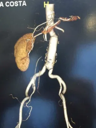 Figure 1. Angio-CT: Dacron graft and infrarenal aortic bypass  anastomosis without pseudoaneurysm; see infrarenal neck.