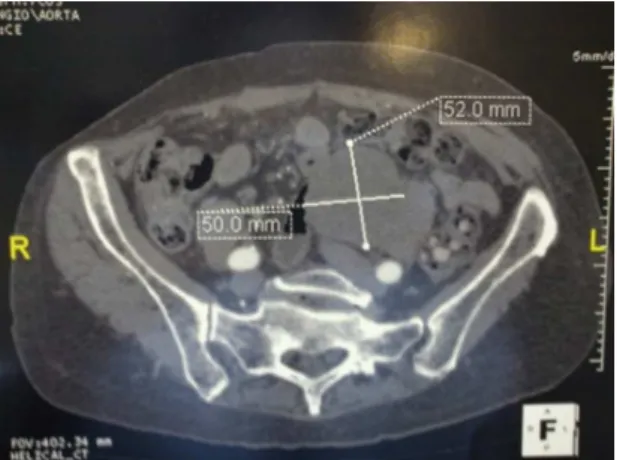 Figure  3. Angio-CT: axial view shows 52-mm pseudoaneu- pseudoaneu-rysm in distal anastomosis.