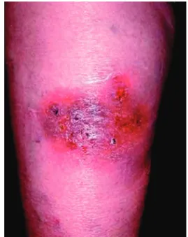 Figure 2. Bullous PG.