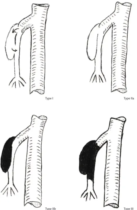 Figure 2. Type I: Patent true and false lumen; Type II: patent true lumen, but no reentry low from the false lumen; Type IIa: visible  false lumen, but not visible reentry site (“blind pouch of false lumen”); Type IIb: no visible false lumen (thrombosed fa