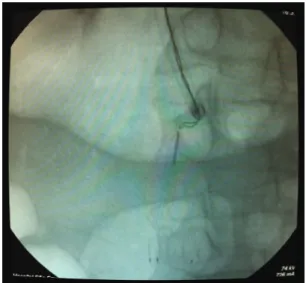 Figure 1. Using the Multi-snare® loop to catch the filter.