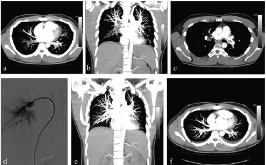 Figure 1. Computed tomography angiography scans (a, b, c) show bilateral massive pulmonary embolism
