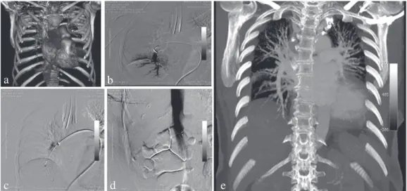 Figure 2. Computed tomography angiography reconstruction (a) and intraoperative arteriogram (b) show one of clots in  pulmonary circulation, as well as device placed in pulmonary artery (c) and vena cava ilter implanted in infrarenal position (d)