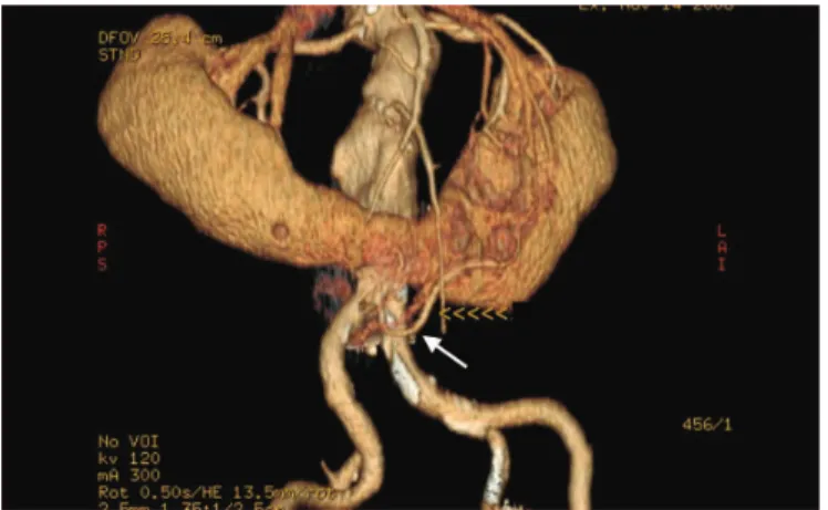 Figure 1. hree-dimensional reconstruction of computed tomographic angiography showing abdominal aortic aneurysm and  horseshoe kidneys