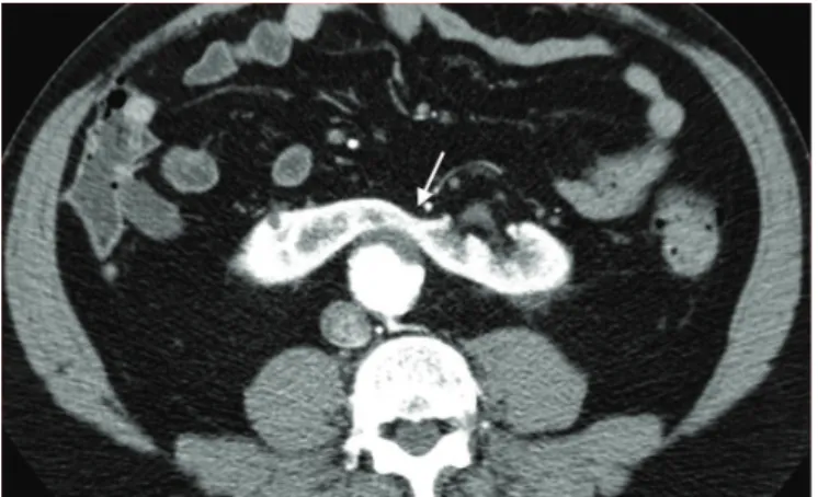 Figure 2. Cross-sectional view of computed tomographic angiography showing renal isthmus composed of parenchymal tissue  (arrow).