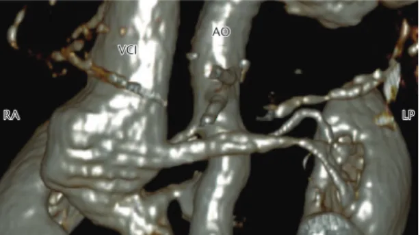 Figure 2. hree-dimensional angiotomography reconstruction  shows connection between abdominal aorta (AO) and inferior  vena cava (IVC).