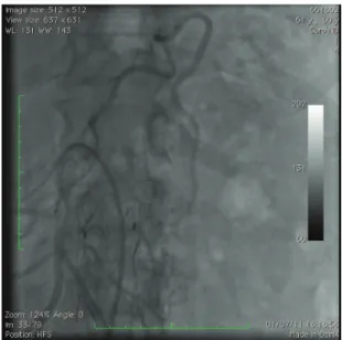 Figure 5. Injection of embolic material to the central point of  leakage and the ostium of the artery responsible for leakage.