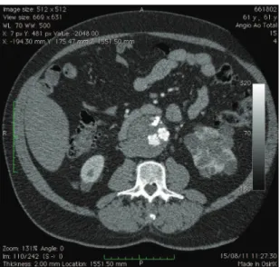 Figure 7. Follow-up computed tomography showing  treatment success. he iodine-impregnated embolic material  can be seen inside the aneurysm sac.