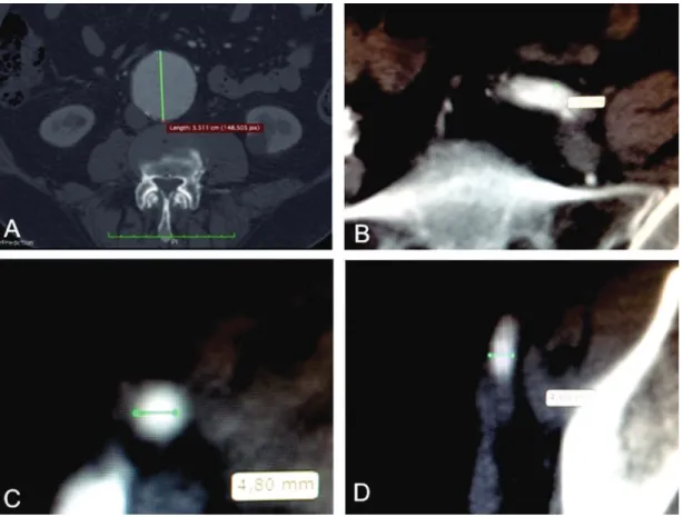 Figure 1. Maximum diameters of the infrarenal AAA (A) and the left common iliac (B), right external iliac (C) and left external iliac  arteries (D), measured during angiotomography.