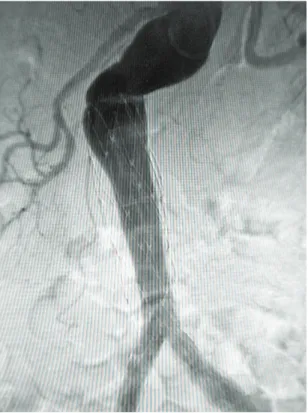 Figure 6. Final control for EVAR. he decision was taken not  to use the proximal extension to the endoprosthesis, since  there was total exclusion of the aneurysm with the  one-piece bifurcated endoprosthesis