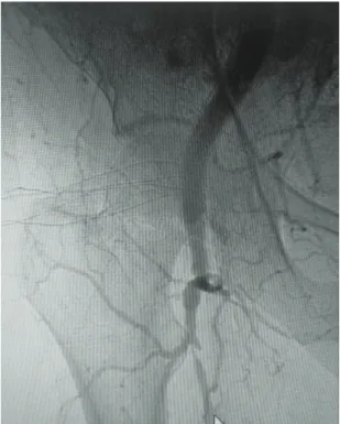 Figure 8. 15 month postoperative angiotomography  reconstruction showing the aortic endoprosthesis  well-positioned and free from leakage, in continuity with the  endoconduit.