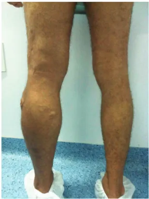 Figure 1. Edema and large caliber varicose veins in the left  lower limb.