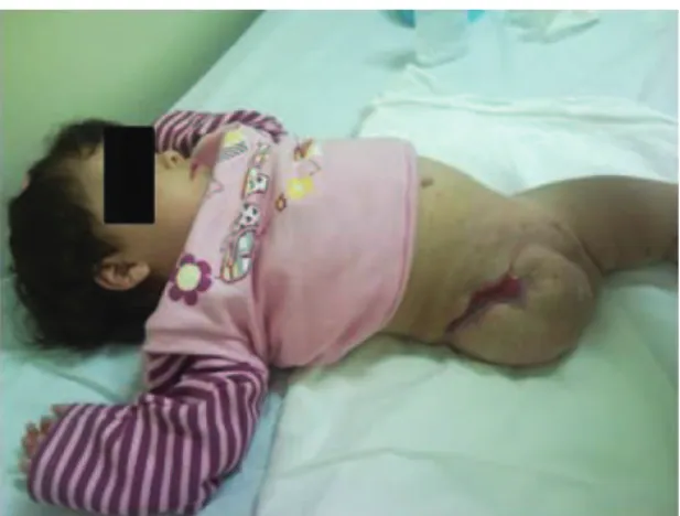 Figure 5. During rehabilitation with prosthesis phase.