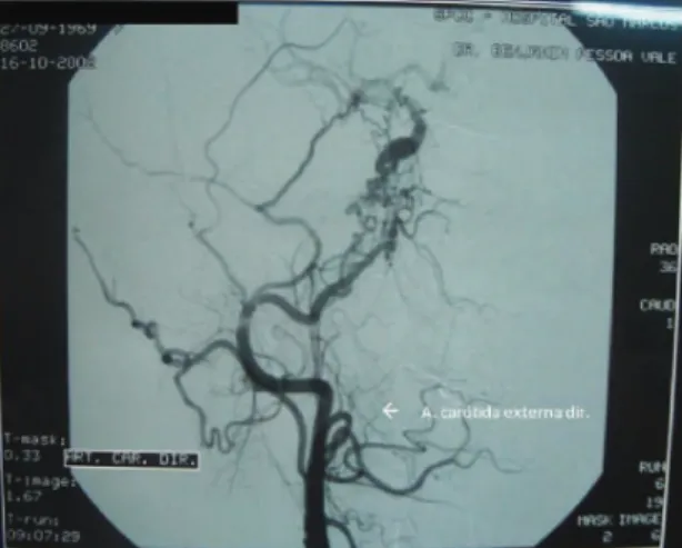 Figure 2. Selective arteriography of the right carotid system,  cervical portion, lateral view; the right internal carotid artery is  not seen in contrast.