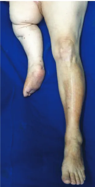 Figure 1. Hypoplastic right lower limb.