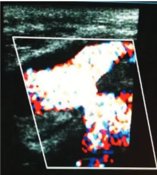 Figure 2. Ultrasonography with Doppler: pseudoaneurysm of  the popliteal artery.