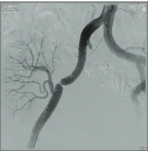 Figure 2. After stent replacement.