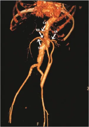 Figure  4. Angio CT in immediate postoperative period  showing visceral branches celiac trunk (CeT), right renal (RR),  left renal (LR) and superior mesenteric (SM).