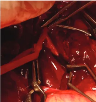 Figure  1. Initial appearance of the aortic bifurcation. An  almost complete rupture was observed.
