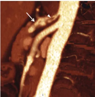 Figure  2. Angiotomography with maximum intensity  projection reconstruction in the sagittal plane showing an  elongated failure to ill the celiac trunk interior (arrowhead)  corresponding to the dissection lap