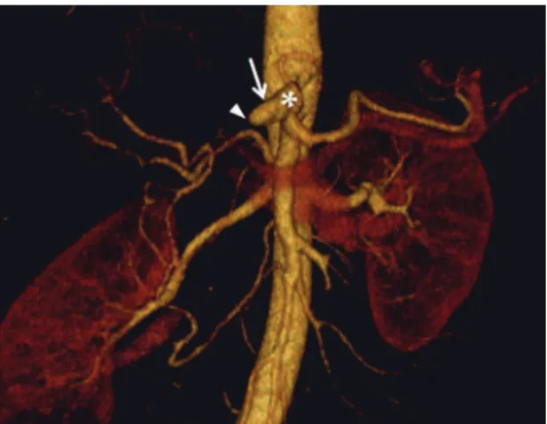 Figure  3. Angiotomography with volume rendering  reconstruction showing the celiac trunk (*), the common  hepatic artery (arrow) and an abrupt interruption in low  (arrowhead) compatible with obstruction by post-dissection  thrombosis.