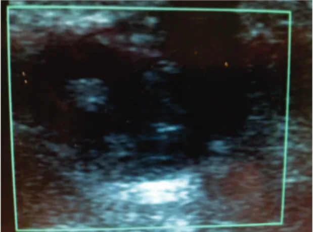 Figure 4. Eight-month follow-up control vascular echography  scan, showing a completely thrombosed pseudoaneurysm in  regression.