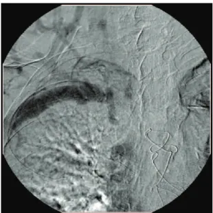 Figure  2. Occlusion of internal jugular vein and right  brachiocephalic trunk, and rich network of collateral veins.