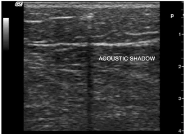 Figure 2. Real-time echo-guided photoablation. hrombus  occludes the target-vein lumen during optical iber pull-back.