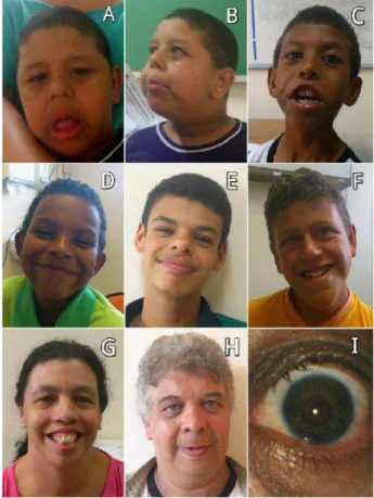 Figure 1 – Facial phenotype of patients at different ages and example of stellate iris pattern