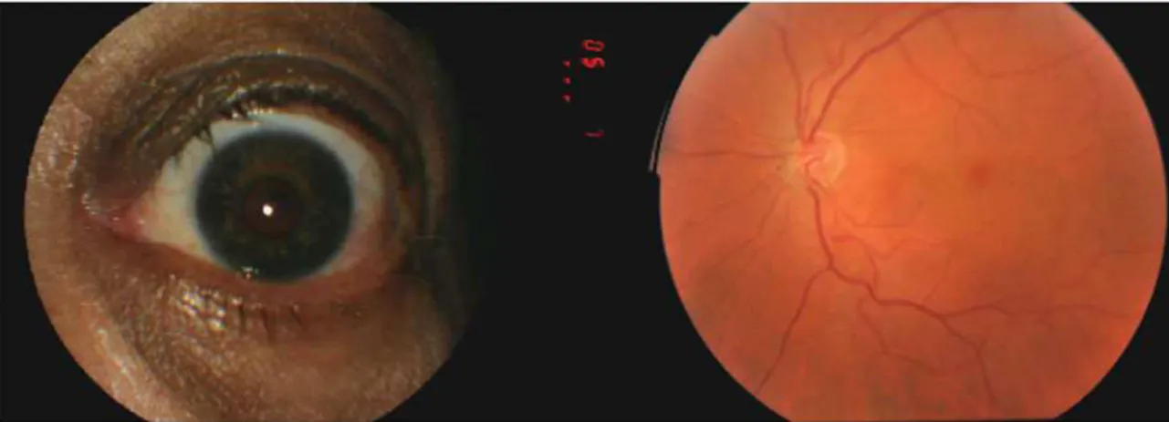 FIGURE 1. Images of (left) stellate iris pattern and (right) tortuous retinal vessels.