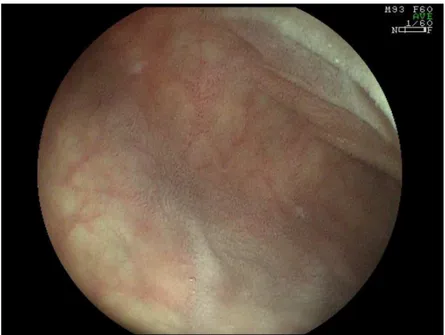 FIGURA 6 - Segunda porção duodenal. Áreas de atrofia vilositária total intercaladas com  áreas de atrofia parcial (patchy villous atrophy)