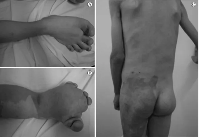 Figure 1. Hypertrophy of both lower limbs, worse on the left (A, B); Hemangioma (C).