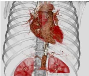 Figure 4. 3D angiotomography reconstruction showing  endoprosthestic repair of aortic pseudoaneurysm.