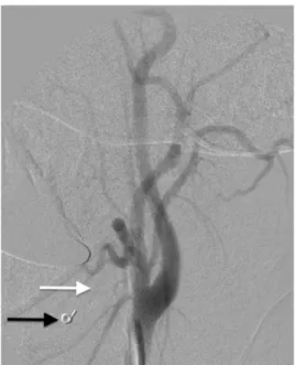 Figure 4. Post-embolization control arteriography. White arrow  – Occluded facial artery