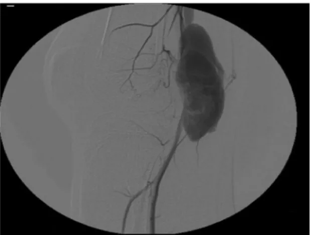 Figure 3. Patient in ventral position, showing location of Z-shaped  incision in the popliteal fossa.