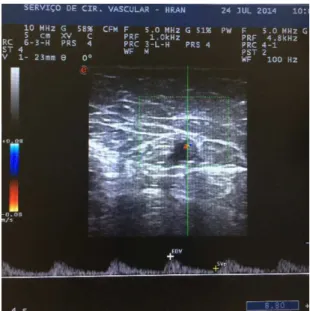 Figure 2. Point of origin of pulsating low within the saphenous  vein lumen.