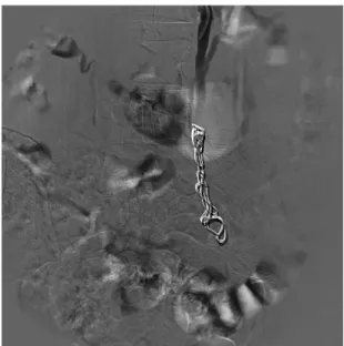 Figure 2. Digital subtraction venography image after embolization  of the left gonadal vein using coils with ibers and dense microfoam.