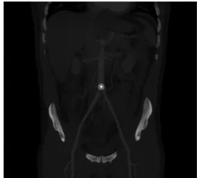Figure 1. Angiotomography showing the Amplatzer   device at  the aortic bifurcation.