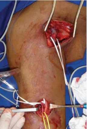 Figure 2. Grafts were bound to the brachial artery and axillary vein  using 119×90mm prolene end-to-side sutures (300 × 300 DPI).