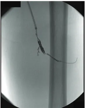 Figure 2. Release of microcoils to seal the communication with  the pseudoaneurysm.
