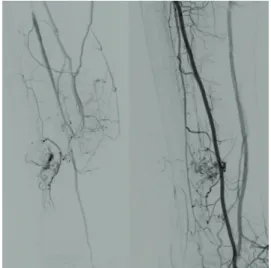 Figure 3. Left: arteriography of hypervascular nodule. Right: inal  result after embolization.