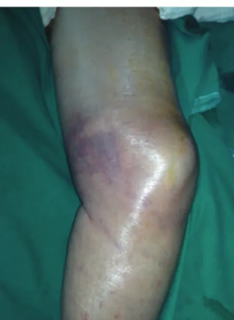 Figure 1. Preoperative presentation. Image of medial surface of  the thigh, showing voluminous hematoma and ecchymosis of  subcutaneous tissues.