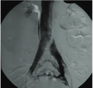 Figure 1. Classic phlebographic indings of IVCS: impression of  the right common iliac artery crossing the left common iliac  vein (a subtraction image), discrete venous dilation and pelvic  collateral circulation.