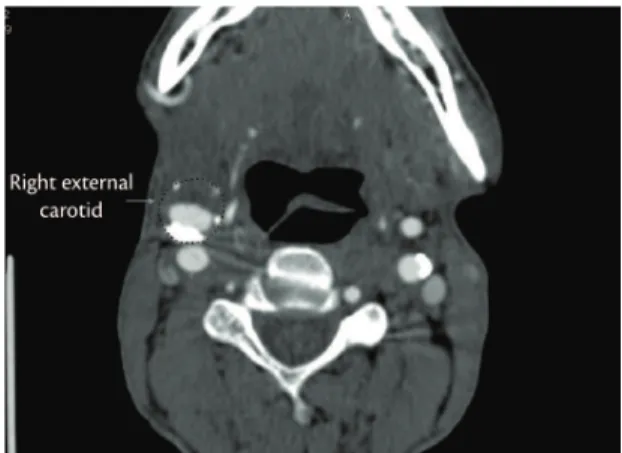 Figure 2. Surgical exposure of the branches of the common  carotid.