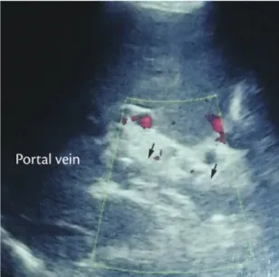 Figure 1. Ultrasonography showing the portal vein with a  hyperechoic thrombus and echogenic foci, which cause a  posterior acoustic shadow