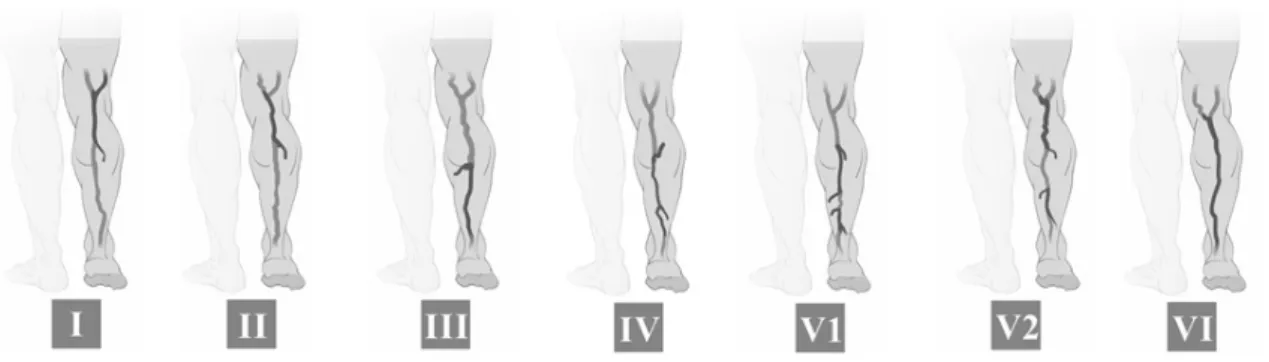 Figura 2. Padrões de reluxo da veia safena parva: I) Padrão de reluxo em perijuncional; II) Padrão de reluxo proximal; III) Padrão  de reluxo distal; IV) Padrão de reluxo segmentar; V1) Padrão de reluxo multissegmentar sem reluxo em JSP; V2) Padrão de  rel