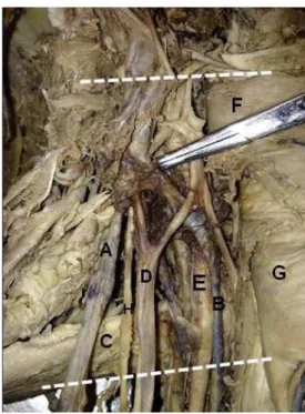 Figure 3. Left axilla, in (A) accessory axillary vein; (B) the axillary  vein; (C) teres major muscle; (D) lateral fascicle; (F) pectoralis  minor m.; (G) pectoralis major m.; (H) musculocutaneous n